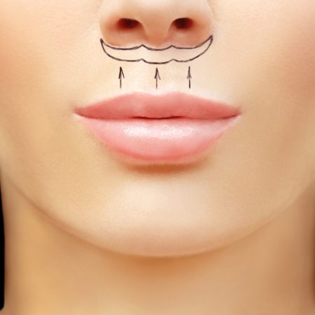 lift lip otros tratamientos medicina estética madrid